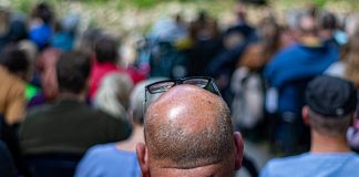¿Sufres de alopecia? No estás solo, el 50% de los Españoles están afectados. Alopecia en España